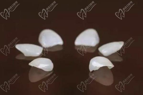 牙齒貼面多久可以做好？