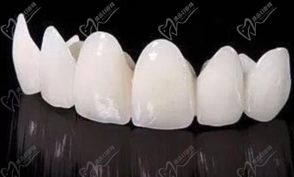 請問牙齒貼面跟全瓷冠的區(qū)別有哪些？