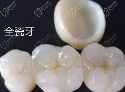 請問牙齒貼面跟全瓷冠的區(qū)別有哪些？