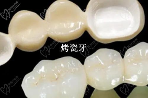 各地區(qū)牙齒貼面多少錢？2025價格表：