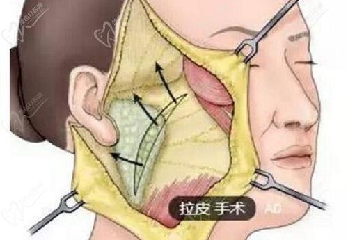 拉皮手術(shù)哪里的整容醫(yī)院做的好？