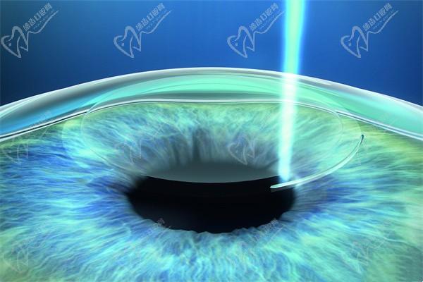 趙立全手術(shù)做的好嗎？坐診上海醫(yī)大眼科飛秒/晶體近視手術(shù)拿手