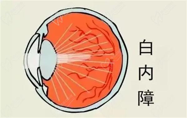 上海醫(yī)大眼科白內(nèi)障手術(shù)8千-3萬起，不同品牌晶體價(jià)格有些許差異